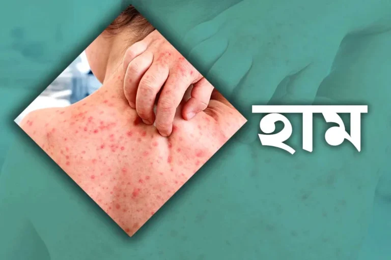 হাম ও উপসর্গে ২৪ ঘণ্টায় আরও ৫ মৃত্যু, মোট প্রাণহানি ১২০১